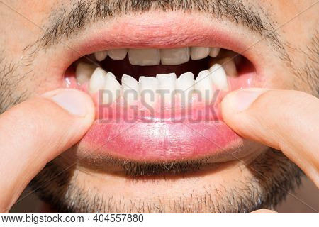 Close Up Of Man Mouth With Crooked Teeth. Reason To Install Teeth Braces. Bad Teeth
