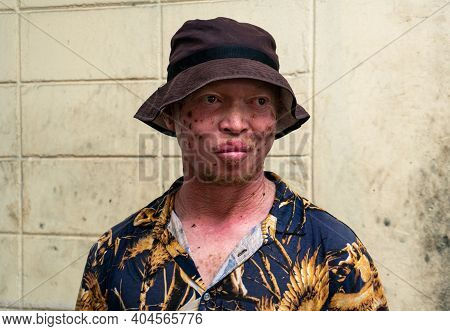 Dar Es Salaam - Tanzania - January 2020: Portrait Of Unidentified Male Albino Worker On A Market In 