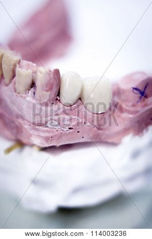 Dental Prosthetics Clay Tooth Mold