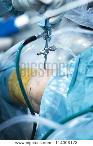 Knee Arthroscopy Orthopedic Surgery Operation