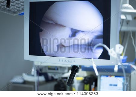 Hospital Surgery Arthroscopy Operation Screen