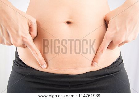 C section Cesarean operation heal after