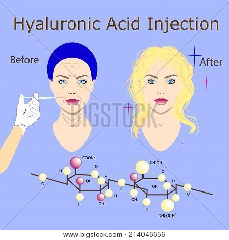 hyaluronic acid injection, before and affect , vector illustration, chemical formulae, two faces