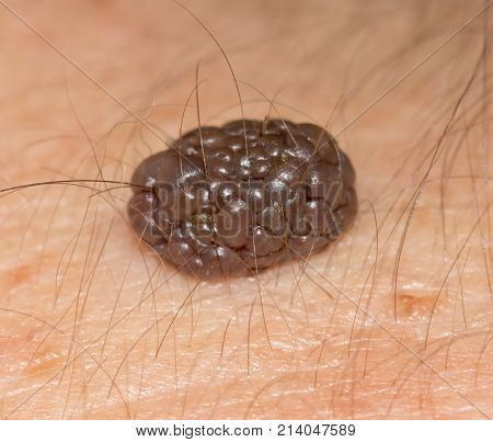 a mole on the skin. macro . Photos in the studio