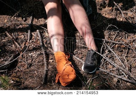 Sunburnt On Skin