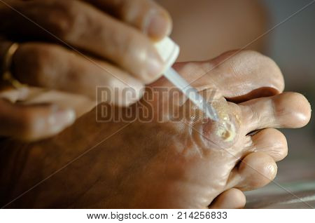 light from LED lighting focus about treatment wart on foot by salicylic acid.
