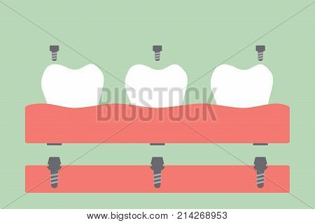 Dental Prostheses, Filling Denture On Gum
