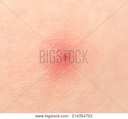 bee sting on the skin. macro . Photo of an abstract texture