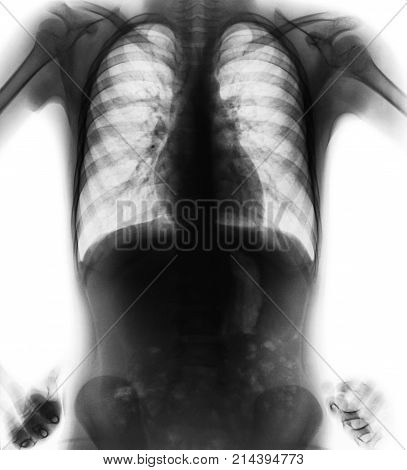 Normal Film Chest X-ray ( Akimbo Position ) ( Front View )