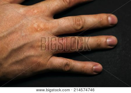 Hand dermatitis. Hand eczema closed on black background