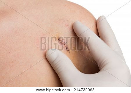 Medic Or Nurse Hands Examining Fresh Suture On Woman Shoulder