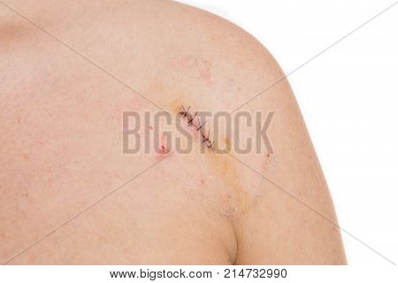 Birthmark Or Mold Removal Concept With Stitches Or Strings