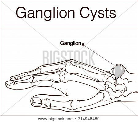 Ganglion cyst  black and white  vector drawing .