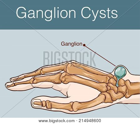 Ganglion cystic vector drawing on blue background