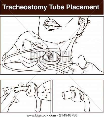 vector illustration of a tracheostomy tube placement.