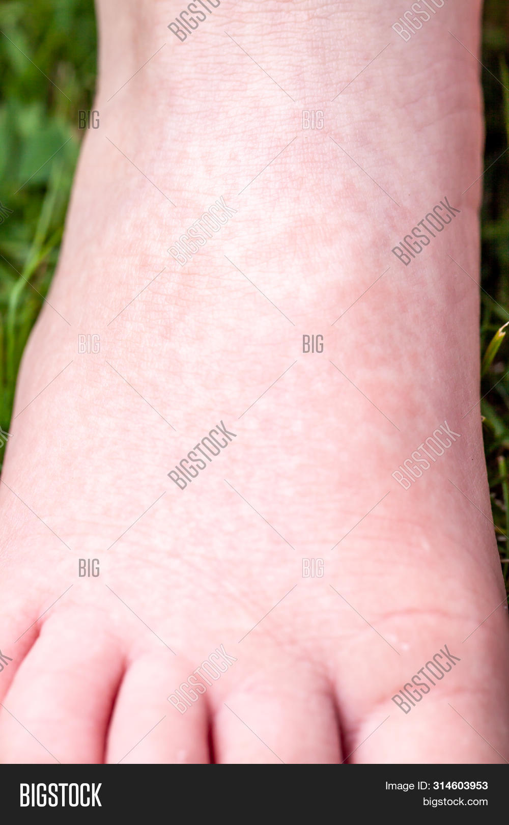 Imagen y foto Scarlet Fever (prueba gratis) Bigstock