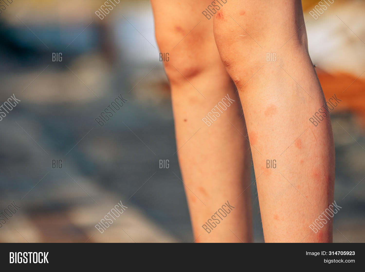 Traces Mosquitoes Image & Photo (Free Trial) Bigstock