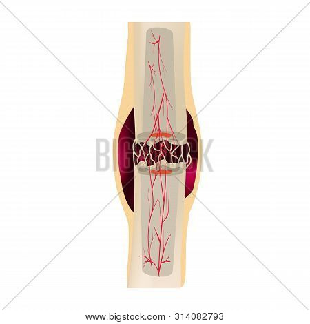 2 Stage Of Healing Bone Fracture. Formation Of Callus. The Bone Fracture. Infographics. Illustration