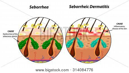 Causes Seborrhea Skin And Hair. Dandruff Seborrheic Dermatitis. Eczema. Dysfunction Of The Sebaceous