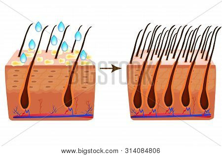 Treatment Of Alopecia. Vitamins Hair. Biotin. Seborrhea Skin And Hair. Dandruff, Seborrheic Dermatit