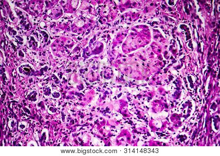 Histopathology Of Biliary Liver Cirrhosis, Light Micrograph, Photo Under Microscope