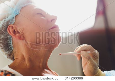 Aged Woman Doing Mesothreads And Thread Lifting, Cosmetology. Cosmetic Procedure To Eliminate Signs 