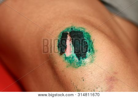 Healing Wound On The Knee. The Wound Treated With Brilliant Green. The Scab Will Climb