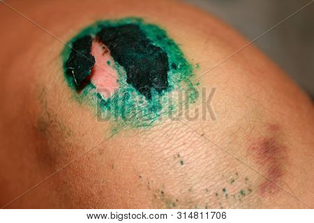 Healing Wound On The Knee. The Wound Treated With Brilliant Green. The Scab Will Climb