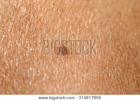 Burn On The Skin. Blister On The Skin