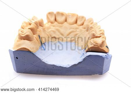 Model Of Tooth Prothesis
