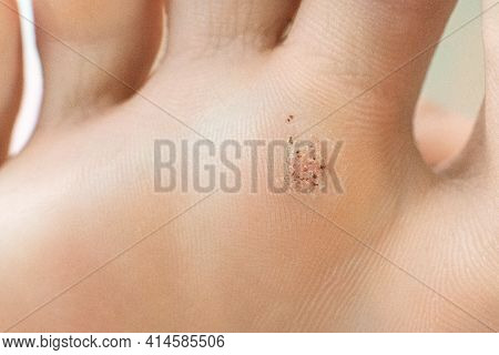 Wart On A Blunt Close-up. Macro Shot Of Human Papilloma On The Foot