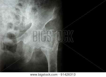Intertrochanteric ( Neck Of Femur ) Fracture Left Femur ( Thigh Bone ) And Blank Area At Right Side