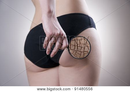 Fatty Female Buttocks