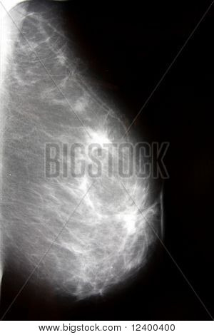 foto di mammografia a raggi x