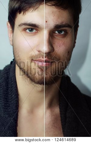 Before and after cosmetic operation. Young man portrait isolated on a white background. Before and after cosmetic or plastic procedure anti-age therapy removal of acne retouching. studio shot