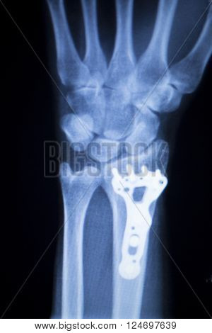 Wrist Injury Metal Implant Xray Scan