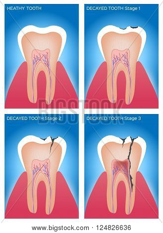 Preview
Save to a lightbox
 Find Similar Images  Share
Stock Vector Illustration:
tooth and gum anatomy and damage