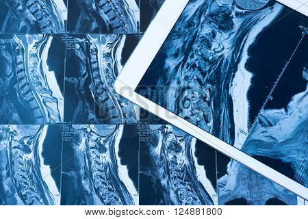 MRI Pictures of spinal column , Doctor pointing to the problem