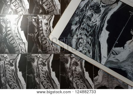 MRI Pictures of spinal column with magnification on overlaying tablet