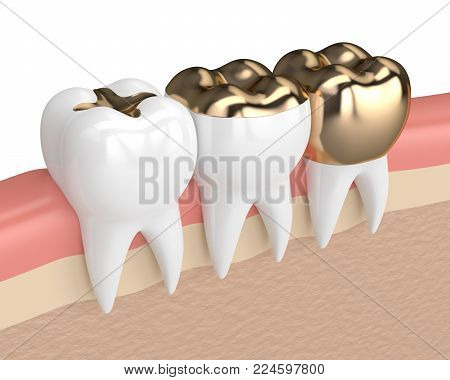 3d render of teeth with inlay, onlay and crown gold filling in gums