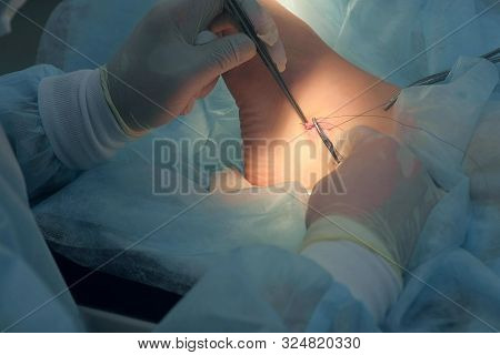 Surgeon Man Sutures Ankle During Surgery With Neat Stitches After Removing Hygroma Using Clip, Hands