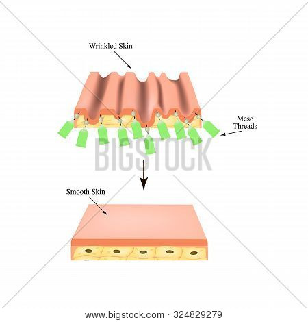 Mesotherapy Threads Lifting. Threads For Facelift. The Structure Of The Skin. Wrinkles. Infographics