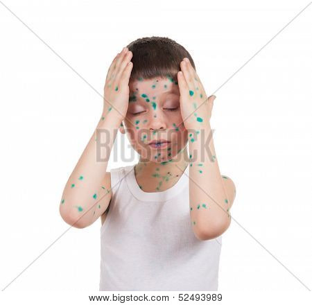 acne on child. chickenpox
