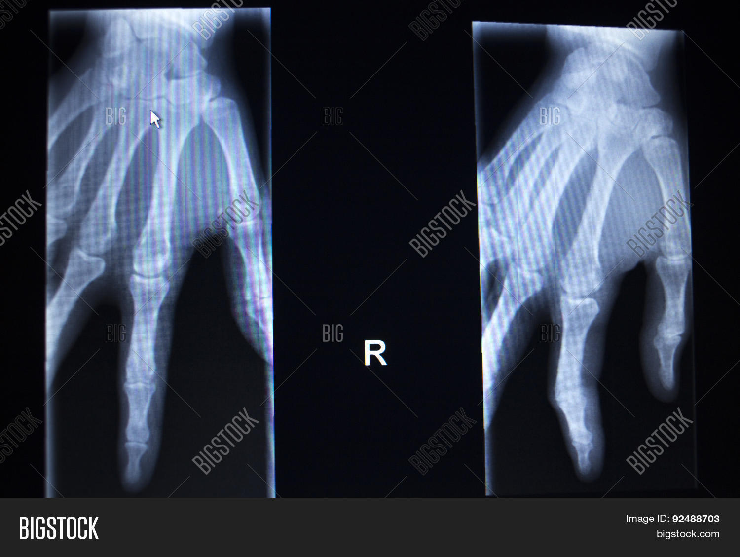 Xray Orthopedics Image & Photo (Free Trial) Bigstock