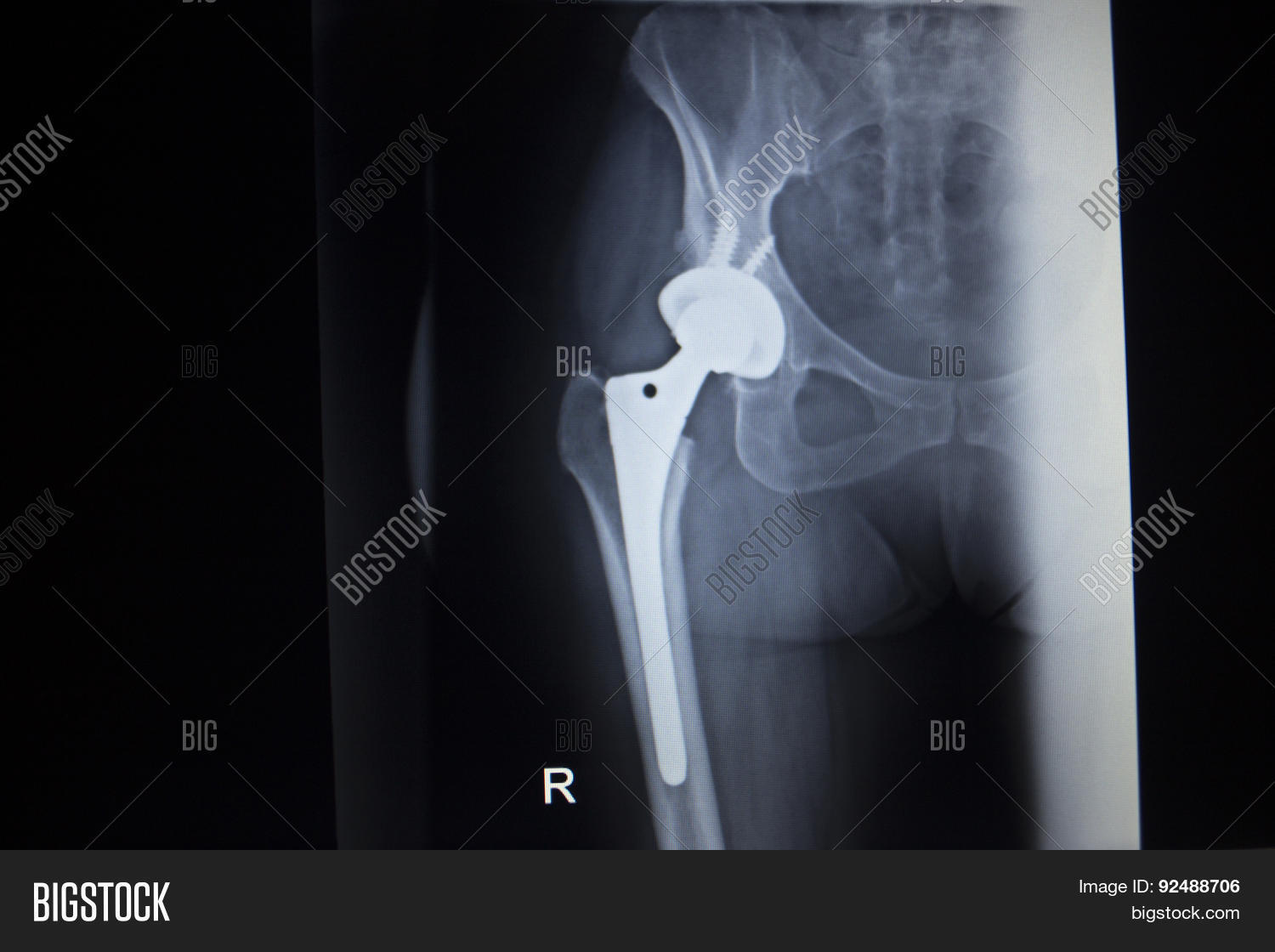 Xray Scan Image Hip Image & Photo (Free Trial) Bigstock