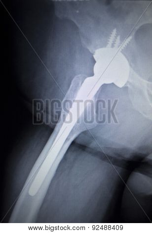 X-ray Scan  Image Of Hip Joint Replacement Orthopedic Implant