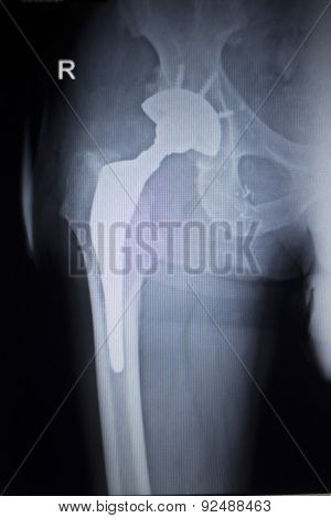 X-ray Scan  Image Of Hip Joint Replacement Orthopedic Implant