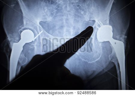 X-ray Scan  Image Of Hip Joint Replacement Orthopedic Implant