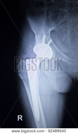 X-ray Scan  Image Of Hip Joint Replacement Orthopedic Implant