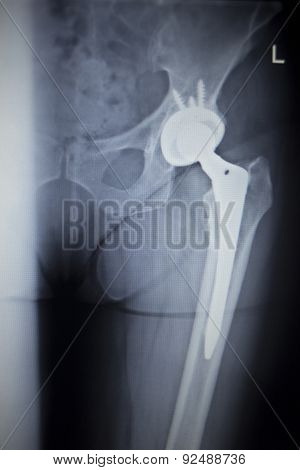 X-ray Scan  Image Of Hip Joint Replacement Orthopedic Implant